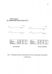 Способ лечения полинейромиопатии критических состояний у реанимационных больных (патент 2666942)