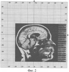 Способ прижизненного определения пространственных координат точки головного мозга (патент 2365331)