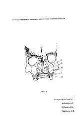 Малотравматичная методика остеотомии верхней челюсти (патент 2625897)