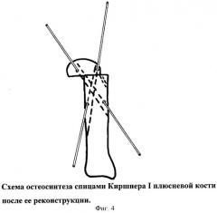 Способ лечения поперечного плоскостопия (патент 2297803)