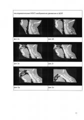 Способ функциональной мультиспиральной компьютерно-томографической диагностики нестабильности позвоночно-двигательных сегментов шейного отдела позвоночника (патент 2637829)