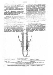 Устройство для удаления инородного тела из полости (патент 1650109)