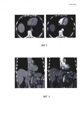 Способ оценки риска фрагментации опухолевого тромба при хирургическом вмешательстве у больных раком почки (патент 2593359)