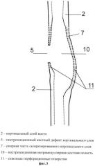 Способ лечения хронического остеомиелита длинных костей конечностей (патент 2544303)