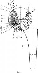 Закрытый эндопротез тазобедренного сустава (патент 2605149)