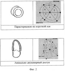 Способ эхокардиографической диагностики поражения миокарда новорожденных (патент 2266708)