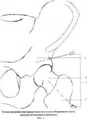 Способ внутрикостного введения лекарственных препаратов при болезни легга-кальве-пертеса (блкп) (патент 2367478)