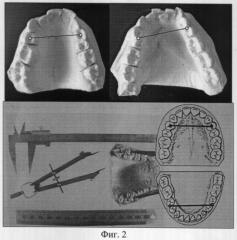 Способ оценки аномалий зубных рядов в трансверсальном направлении (варианты) (патент 2310420)