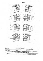 Способ устранения двустороннего анкилоза височно- нижнечелюстного сустава и недоразвития нижней челюсти (патент 1819573)