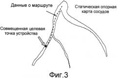 Картирование сердца (патент 2461881)