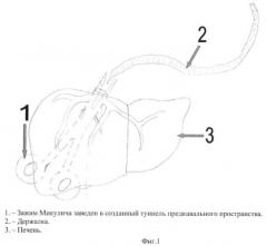 Способ левосторонней гемигепатэктомии (патент 2464941)