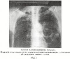 Способ хирургического лечения туберкулеза легких (патент 2417762)
