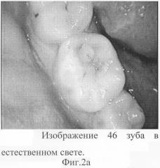 Дентальная флюоресцентная видеокамера (патент 2286081)