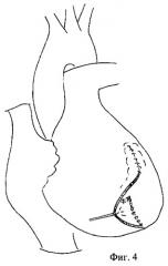 Способ закрытия постинфарктного межжелудочкового дефекта с одновременным устранением аневризмы сердца (патент 2266714)
