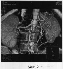 Способ исследования висцеральных ветвей брюшной аорты методом компьютерно-томографической ангиографии с последующей их трехмерной реконструкцией (патент 2303400)