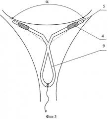 Способ внутриматочной контрацепции и внутриматочное контрацептивное средство (патент 2316293)