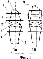 Способ удлинения коротких культей пальцев кисти (патент 2428940)