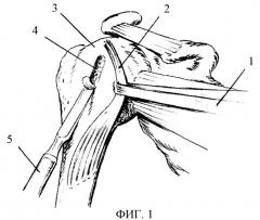 Способ хирургического лечения привычного вывиха плеча (патент 2392895)