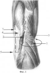 Способ восстановления активного сгибания в локтевом суставе у детей с вялыми параличами верхней конечности (патент 2497474)