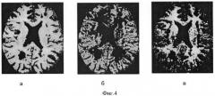Способ определения тяжести дегенеративных изменений в головном мозге больных рассеянным склерозом (патент 2426495)