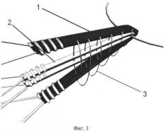 Способ формирования крестообразных связок коленного сустава (патент 2424779)