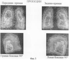 Способ диагностики тромболии мелких ветвей легочной артерии (патент 2303950)