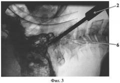 Способ остеосинтеза поврежденного зубовидного отростка второго шейного позвонка (патент 2551226)