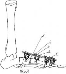 Способ хирургической реабилитации больных с "hallux valgus" (патент 2259174)