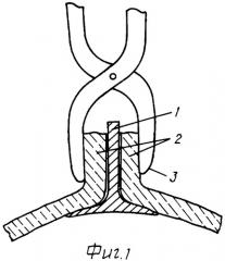 Способ наложения разъемной гипсовой повязки (патент 2336063)