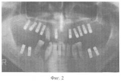 Способ дентальной имплантации верхней челюсти (патент 2266720)