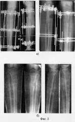 Способ удлинения длинных трубчатых костей (патент 2281707)