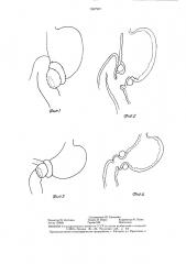 Способ резекции желудка (патент 1387997)