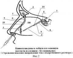 Двухпросветная канюля для промывания околоносовых пазух (патент 2318540)