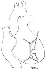 Способ закрытия постинфарктного межжелудочкового дефекта с одновременным устранением аневризмы сердца (патент 2266714)