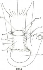 Способ оперативного лечения свежего подкожного разрыва ахиллова сухожилия (патент 2433795)