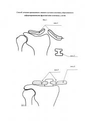 Способ лечения врожденного ложного сустава ключицы, образованного деформированными фрагментами ключицы у детей (патент 2651124)