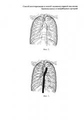 Способ катетеризации и способ эндоваскулярной окклюзии бронхиальных и межрёберных артерий (патент 2661097)