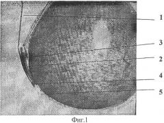 Способ хирургического лечения прогрессирующей миопии (патент 2317049)