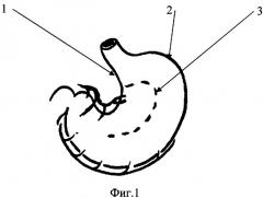 Способ создания желудочной трубки для пластического замещения пищевода (патент 2332173)