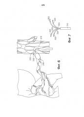 Нервы, подвергающиеся целевой абляции, в нижней полой вене и/или брюшной аорте рядом с ними для лечения гипертензии (патент 2610529)