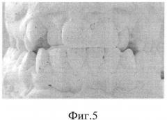 Способ трансверзального расширения верхнего зубного ряда (патент 2559762)