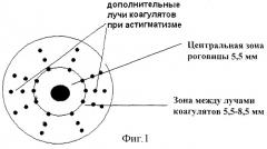 Способ лечения гиперметропической анизометропии у детей и подростков (патент 2278647)