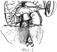 Способ хирургического лечения асептического панкреонекроза (патент 2557417)