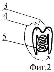 Вильчатая пластинка для остеосинтеза переломов и ложных суставов ключицы (патент 2254090)