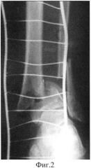 Способ временной фиксации внутрисуставных переломов дистального отдела костей голени (патент 2564080)