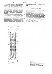Устройство для фиксации костных фрагментов (патент 862937)