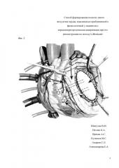 Способ формирования полости левого желудочка сердца, максимально приближенной к физиологичной, у пациентов с переднеперегородочными аневризмами при его реконструкции по методу l. menicanti (патент 2620049)