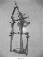 Способ лечения переломов проксимального отдела бедренной кости (патент 2477089)