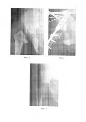 Способ лечения патологического вывиха бедра (патент 2611884)