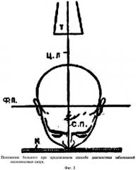 Способ рентгенографии околоносовых пазух (патент 2309676)